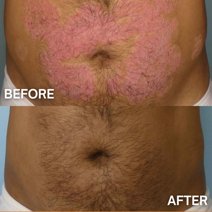 DermaCalm™ – Psoriasis Relief Cream