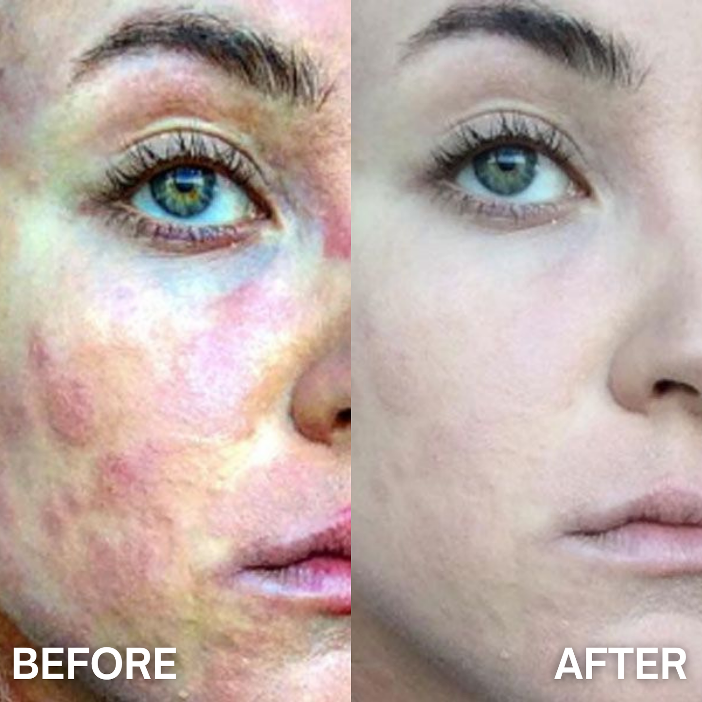 DermaCalm™ – Psoriasis Relief Cream