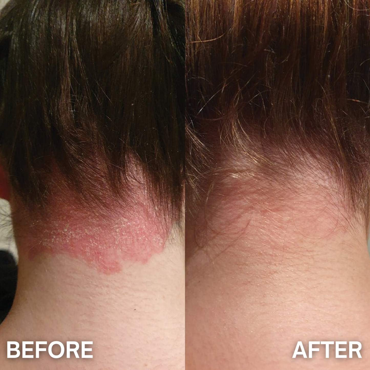 DermaCalm™ – Psoriasis Relief Cream