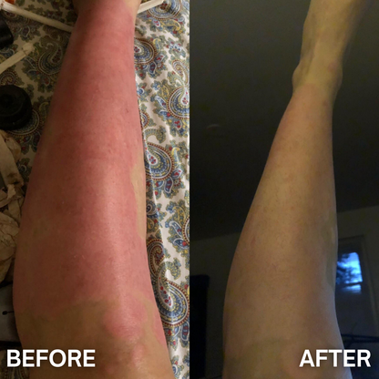 DermaCalm™ – Psoriasis Relief Cream